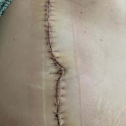Laparotomy incision. Laparotomy incision.