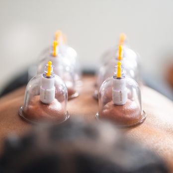 Wildflower Physical Therapy & Wellness - Cupping can help reduce pain and increase blood flow - Physical Therapy Near Me - Indianapolis, Indiana Wildflower Physical Therapy & Wellness - Cupping can help reduce pain and increase blood flow - Physical Therapy Near Me - Indianapolis, Indiana