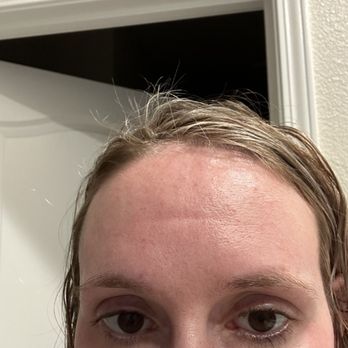 Davis Dermatology - AFTER photo (3 days later...) - Medical Spas Near Me - Davis, California Davis Dermatology - AFTER photo (3 days later...) - Medical Spas Near Me - Davis, California