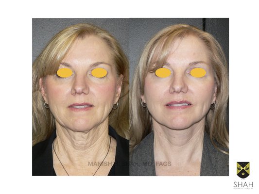 Shah Aesthetic Surgery - Rhinoplasty and Facelift Specialist by null