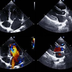 Abington Cardiology: Arnold Meshkov, MD, FACC - In-Office Echocardiograms