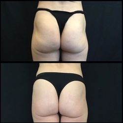 Encore Medspa - A total of 12 vials over 4 treatments of Sculptra give this booty a lift that makes it hard to believe she is 50 years old.