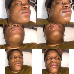 Sala Aesthetics - Before and After It's The Glow For Me Facial