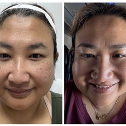 South Coast MedSpa - Before my first treatment in 2/2024 on the left and me now after a Morpheus 8 treatment on the right.