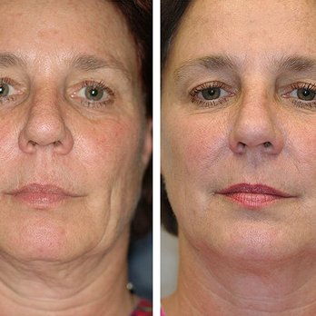 Oya Aesthetics Center - Thermage face tightening treatment - Medical Spas Near Me - Rowland Heights, California Oya Aesthetics Center - Thermage face tightening treatment - Medical Spas Near Me - Rowland Heights, California