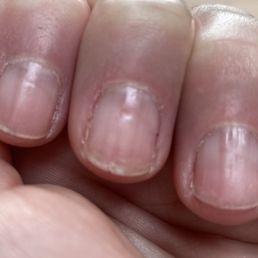 Divots in my natural nails from electric drill.