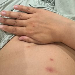 Bug bite from K1 speed sofa
