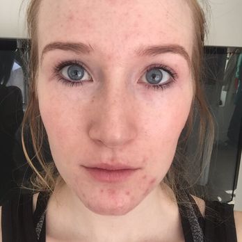 Face Five Acne Clinic - Before. - Skin Care Near Me - Colorado Springs, Colorado