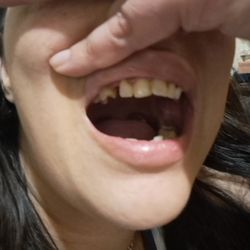 Dental House of Ann Arbor - Dental house broke my teeth and denies it