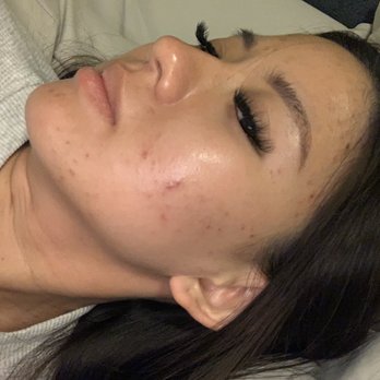 AWESTHETICS - Right after facial - Skin Care Near Me - Huntington Beach, California AWESTHETICS - Right after facial - Skin Care Near Me - Huntington Beach, California
