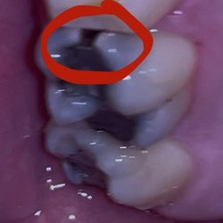 Initial cracked tooth