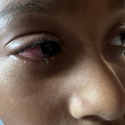 Imperatori Family Martial Arts Center - Traumatic hyphema