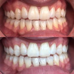 Beauty By Kendra - Before & after 1 hour of teeth whitening
