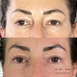 Beauty by Cady - Fibroblast eyelid and under eye bags, 4 month post treatment @beautybycady