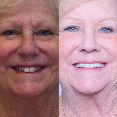 Crowns-Smile Makeover - We can plan your case with Digital Smile Design (DSD), a transformative approach that leverages digital technology to plan and create personalized smile makeovers. Cosmetic Dentist use this method to enhance predictability, involve patients in the treatment process, and streamline treatment planning, DSD has become a game-changer in the quest for natural and attractive smiles.