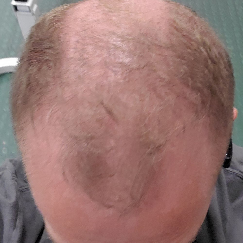 SMP INK - Before. - Hair Loss Centers Near Me - Las Vegas, Nevada SMP INK - Before. - Hair Loss Centers Near Me - Las Vegas, Nevada
