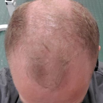 SMP INK - Before. - Hair Loss Centers Near Me - Las Vegas, Nevada