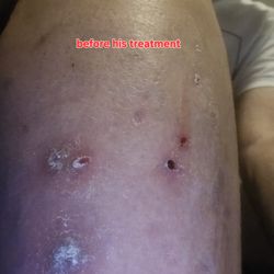 Omni Dermatology - I had this problem all over my skins. Thanks to Dr Craig Wiggins all of these problems are gone for good.