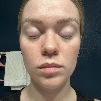 Face to Face Spa - Before - Medical Spas Near Me - Austin, Texas