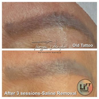 Lush Brow Artistry - Saline Tattoo Removal after 3 sessions (number of sessions required varies by case) - Permanent Makeup Near Me - Park Ridge, Illinois Lush Brow Artistry - Saline Tattoo Removal after 3 sessions (number of sessions required varies by case) - Permanent Makeup Near Me - Park Ridge, Illinois