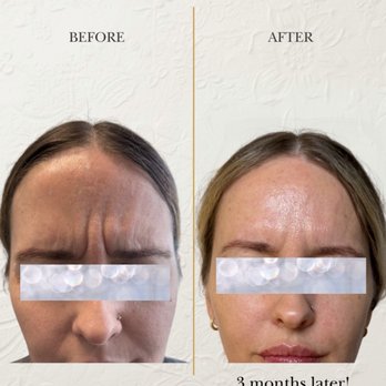 LA Mi Spa - Proof that you can wait longer than 3 months for tox - Medical Spas Near Me - Los Angeles, California LA Mi Spa - Proof that you can wait longer than 3 months for tox - Medical Spas Near Me - Los Angeles, California