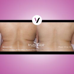 Level Up Med Spa - TruSculpt iD is a new noninvasive radiofrequency fat-eliminating treatment that is performed in less than 20 minutes!