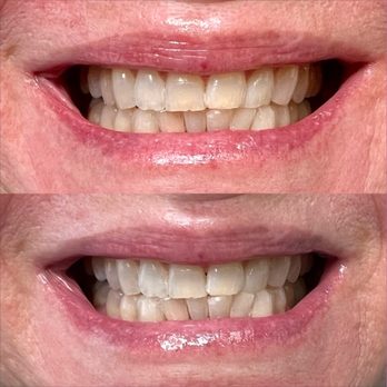 HySmiles - Teeth Whitening Near Me - San Jose, California HySmiles - Teeth Whitening Near Me - San Jose, California