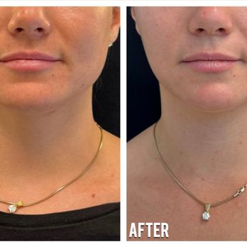 SORAH Aesthetics - Masseter slimming with Botox for a softer, more symmetrical jawline. After photo shows a slimmer, balanced contour. - Medical Spas Near Me - Pleasanton, California
