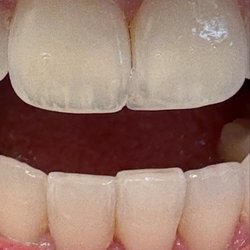 Sawgrass Complete Dentistry - Teeth after bonding procedure