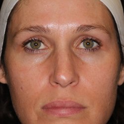 Lupo Center for Aesthetic and General Dermatology - This is my after photo.
