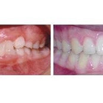 Ian Lennard, DDS MS - Underbite correction - Orthodontists Near Me - San Jose, California Ian Lennard, DDS MS - Underbite correction - Orthodontists Near Me - San Jose, California