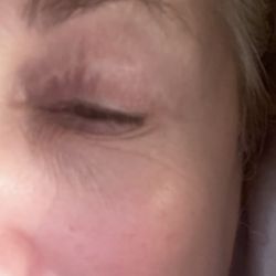 Beauty by Brueck - Dr. Robert Brueck - Eye lift
