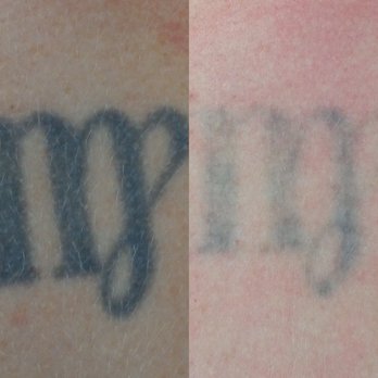 Evolve Tattoo Removal - This is my result with one session ! I still can't believe how much fading it has done. Got my 2nd treatment scheduled today!!! - Tattoo Removal Near Me - San Diego, California Evolve Tattoo Removal - This is my result with one session ! I still can't believe how much fading it has done. Got my 2nd treatment scheduled today!!! - Tattoo Removal Near Me - San Diego, California