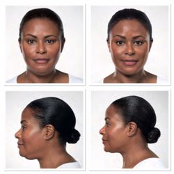 Skin Science - Kybella, Double Chin be gone!!