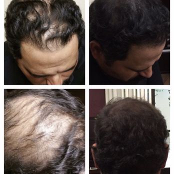 Semper Hair - Hair Loss Centers Near Me - Fresno, California