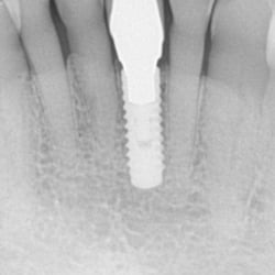 Contemporary Periodontics & Dental Implants - Implant with crown