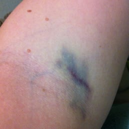 4 days after blood draw