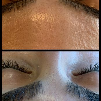 Salon 525 - before & after!! - Skin Care Near Me - Visalia, California Salon 525 - before & after!! - Skin Care Near Me - Visalia, California