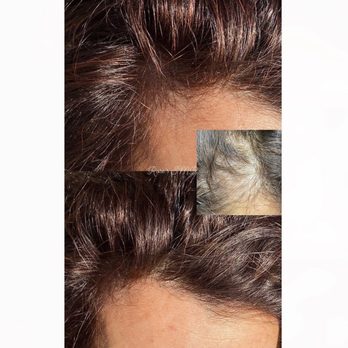 Scalp Micropigmentation by Rose - SMP - Dermatologists Near Me Scalp Micropigmentation by Rose - SMP - Dermatologists Near Me