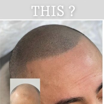 Scalp micro pigmentation by meechi - Scalp micro pigmentation - Hair Loss Centers Near Me - Lansing, Illinois Scalp micro pigmentation by meechi - Scalp micro pigmentation - Hair Loss Centers Near Me - Lansing, Illinois