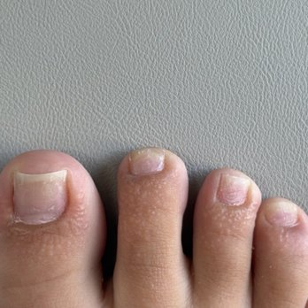 Deluxe Nail Salon - Itchy bumps - Nail Technicians Near Me - Concord, California Deluxe Nail Salon - Itchy bumps - Nail Technicians Near Me - Concord, California