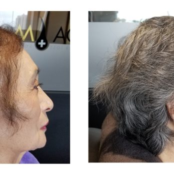 Damo Hair Loss Solution - after chemo - Hair Loss Centers Near Me - Buena Park, California Damo Hair Loss Solution - after chemo - Hair Loss Centers Near Me - Buena Park, California