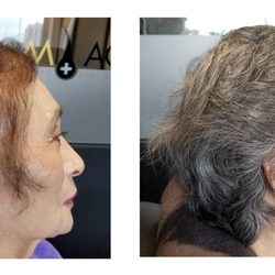 Damo Hair Loss Solution - After chemo