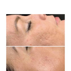 Skin Sational Spa - Microneedling is such an amazing treatment look at those results Book now don't wait