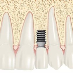 Implant Dentistry of Northshore