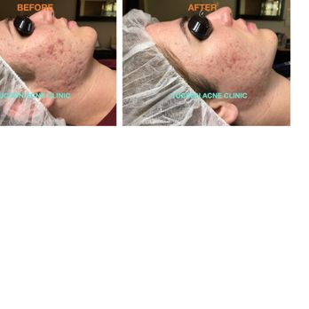 Tucson Acne Clinic - Skin Care Near Me - Tucson, Arizona Tucson Acne Clinic - Skin Care Near Me - Tucson, Arizona