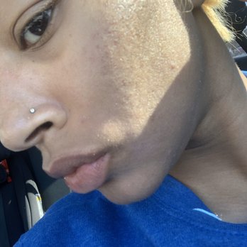 Skin By Shadi - After peel magic - Skin Care Near Me - Kensington, Maryland