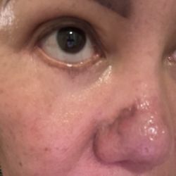 Winds of Change Cosmetic Surgery - Lower eyelid and a scar on my nose.