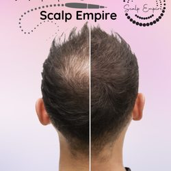 Scalp Empire Studio - SMP solution for thinning hairs