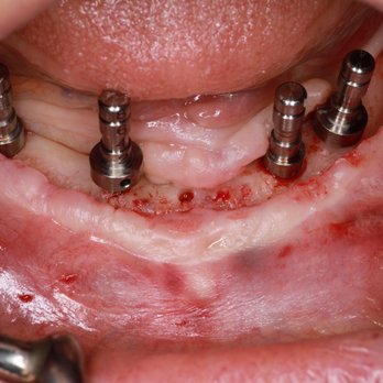 Kasper Denture Clinic - General Dentistry Near Me - Vernon, British Columbia Kasper Denture Clinic - General Dentistry Near Me - Vernon, British Columbia